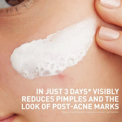 CeraVe 3in1 Acne Clay-to-Foam Facial Cleanser, Mask & Spot Treatment -  4 fl oz